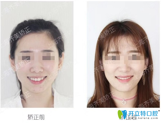 袁峰牙齒矯正前后對比案例 袁峰牙齒矯正前后對比案例