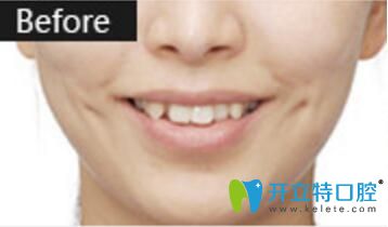 烏魯木齊美奧口腔張翔牙齒矯正真人案例術(shù)前照