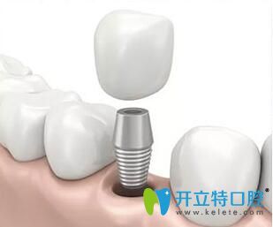 長沙美萊口腔牙齒種植大優(yōu)惠