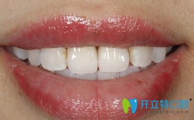 全瓷牙完成后口內(nèi)照片