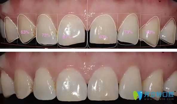 術(shù)前微笑設(shè)計和模擬瓷貼面修復(fù)效果 術(shù)前微笑設(shè)計和模擬瓷貼面修復(fù)效果