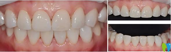 通化愛德口腔瓷貼面修復(fù)效果 通化愛德口腔瓷貼面修復(fù)效果