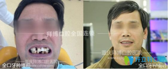 拜博口腔多顆牙缺失種植案例