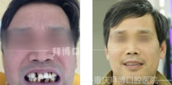 重慶拜博口腔種植牙齒價(jià)格和技術(shù)怎么樣 真人案例現(xiàn)場(chǎng)解答