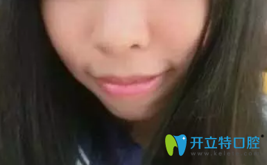 沒(méi)有去深圳河山齒科前次矯正兩年后的照片