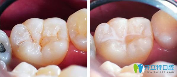 <!--<i data=20240703-sp></i>-->維樂口腔根管治療齲齒補牙后效果 <!--<i data=20240703-sp></i>-->維樂口腔根管治療齲齒補牙后效果