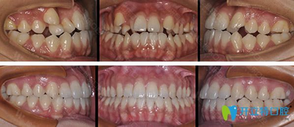維樂口腔因金屬托槽矯正牙齒前后效果對比照 維樂口腔因金屬托槽矯正牙齒前后效果對比照