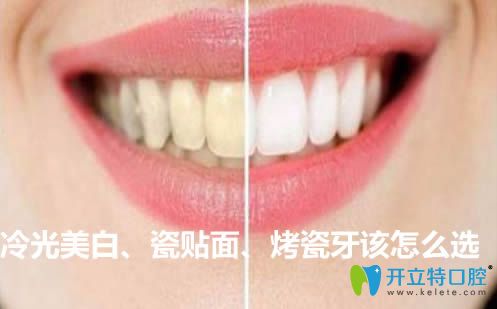 冷光美白和牙齒瓷貼面及烤瓷牙該怎么選?來(lái)看價(jià)格是多少錢