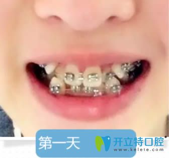佩戴金屬牙套天 佩戴金屬牙套天