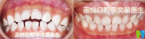 成都茁悅口腔兒童牙齒矯正效果對比圖