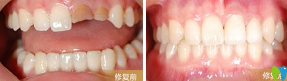 陽(yáng)光樹(shù)口腔烤瓷牙修復(fù)前后效果對(duì)比