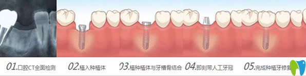 種植牙手術流程