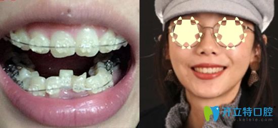  重慶整牙哪家？看重慶樂樂欣口腔牙齒矯正真人案例