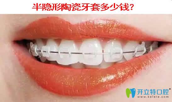 半隱形陶瓷牙套多少錢(qián)？本文提供陶瓷托槽牙齒矯正價(jià)格表