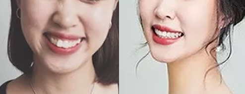 讓大家見證下我在重慶齊美口腔矯正齙牙、兔子牙511天變化