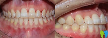 廈門亞歐齒科姚森牙齒正畸術(shù)后效果圖