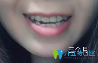 牙齒過度擁擠在深圳鵬程口腔戴隱形牙套3個月時候照片