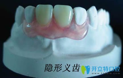 牙醫(yī)解惑:隱形義齒能戴一輩子嗎?隱形牙和烤瓷牙到底哪個好
