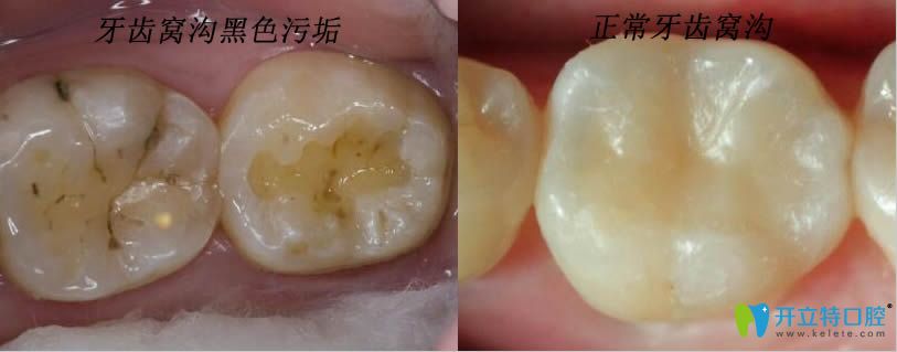 牙齒上的黑色污垢是蛀牙嗎？那蛀牙如何讓它停止腐蝕呢？