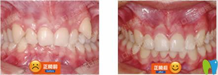 南京博韻口腔青少年虎牙+深覆合矯正前后對比效果