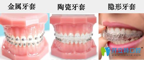 公布牙套價格表(包含金屬托槽/半隱形陶瓷矯正/隱形矯正)