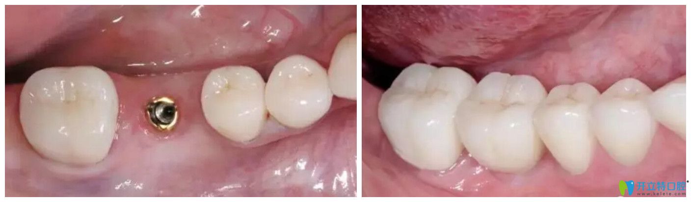 艾芳口腔段銀鈴單顆牙齒缺失種植案例效果前后對(duì)比