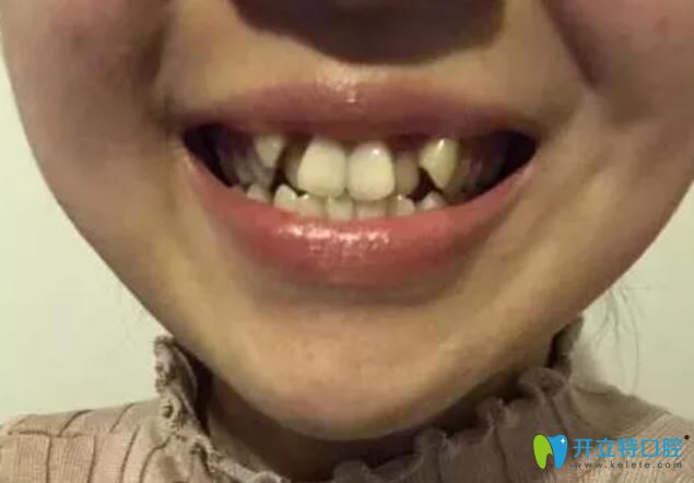 在杭州艾芳口腔矯正牙齒，我拔過牙加過彈簧還上過橡皮筋