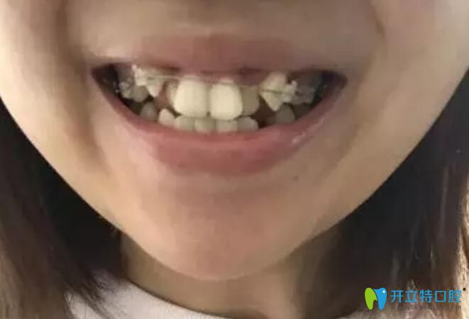 在艾芳口腔初帶牙套照