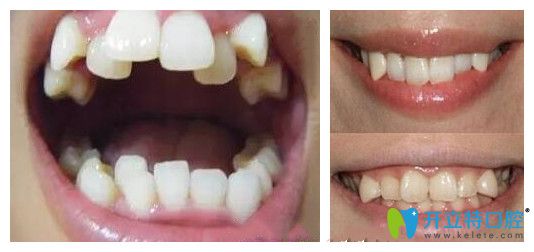 談?wù)劙酥佚X是什么意思以及虎牙和八重牙有區(qū)別嗎？