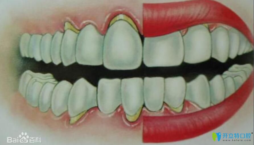 牙槽骨萎縮假牙掛不住，請(qǐng)問牙槽骨萎縮還能恢復(fù)嗎？