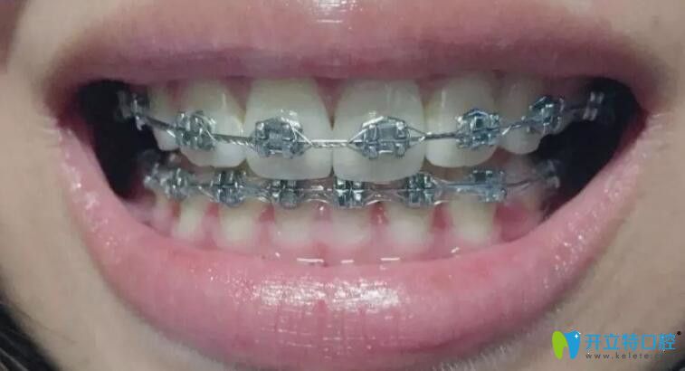 藝星門牙前突戴牙套280天口內照
