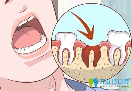 拔牙后要注意口腔護理