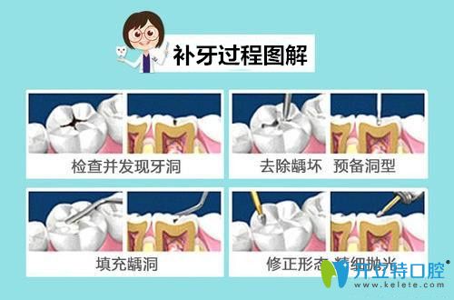先了解補牙材料150和300的區(qū)別,再確定補牙用什么材料好