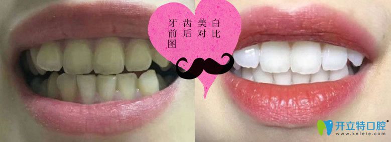 我在東營鉑爾口腔做牙齒美白前后照片