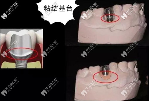 粘結(jié)基臺(tái)的臨床應(yīng)用