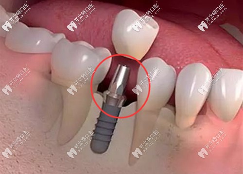 基臺(tái)是種植牙系統(tǒng)中非常重要的一個(gè)部件