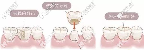 解答：門牙缺了一小塊是選牙齒貼面還是全瓷牙好呢？