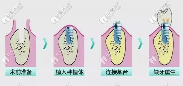 種植牙流程圖示