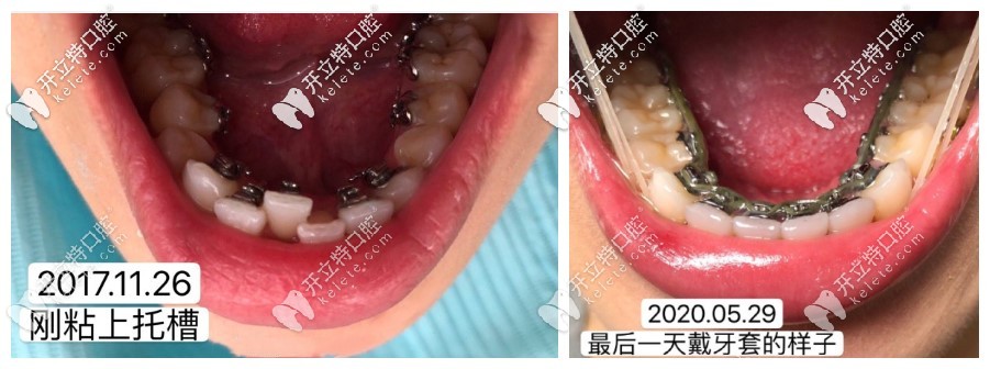 關(guān)注舌側(cè)隱形矯正價格的同時,eBrace舌側(cè)矯正的效果你知道嗎