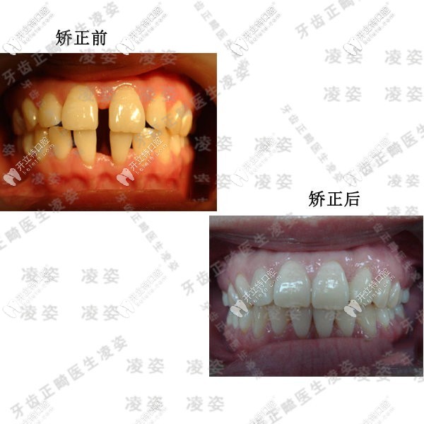 牙縫過(guò)大矯正前后效果圖 牙縫過(guò)大矯正前后效果圖