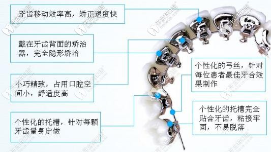 舌側(cè)矯正優(yōu)勢 舌側(cè)矯正優(yōu)勢