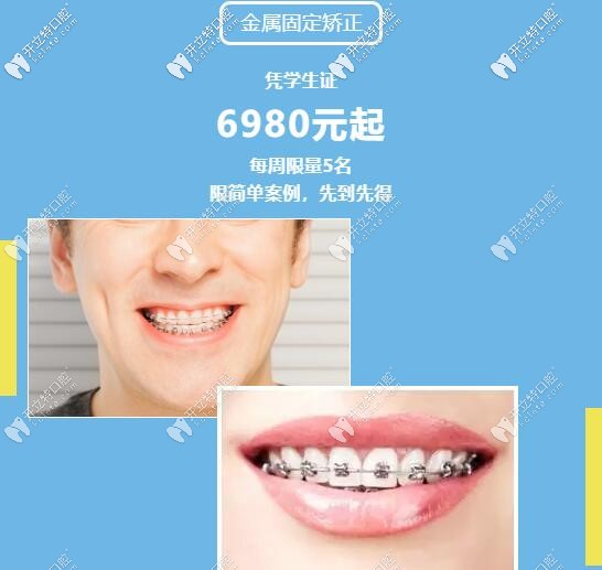 暑期學生做金屬托槽矯正多少錢呢?憑學生證享鋼牙套6980元啦