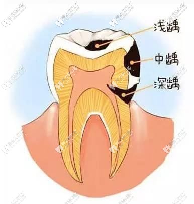  牙醫(yī)科普之哪顆牙齒更容易發(fā)生齲齒,以及發(fā)生齲病的原因