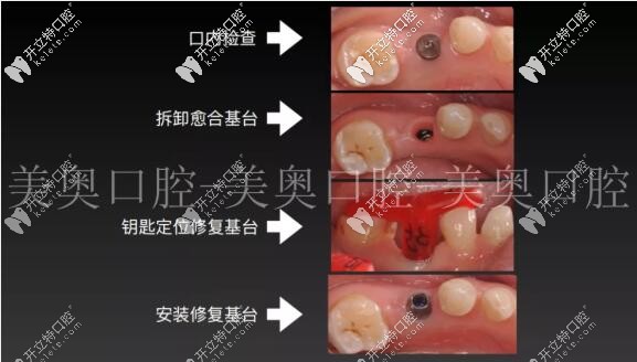 種植牙術后拆卸基臺 種植牙術后拆卸基臺