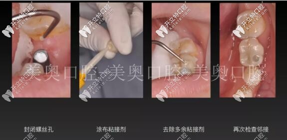 無錫美奧口腔單顆牙冠佩戴 無錫美奧口腔單顆牙冠佩戴