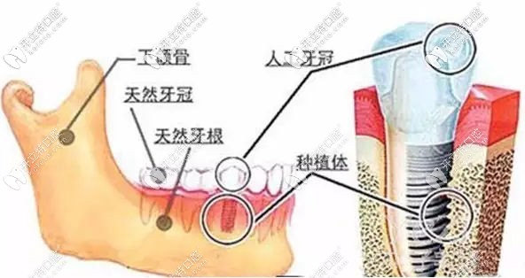 還在問(wèn)西寧做一顆種植牙需要多少錢?這份收費(fèi)清單你沒(méi)看吧