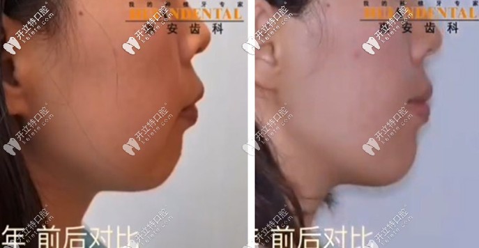 看呆！凸嘴少女在惠安齒科戴自鎖托槽矯正半年后…