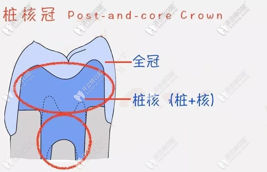 牙根剩4毫米可以做樁冠修復(fù)嗎?基本治療過(guò)程圖解你可以看看