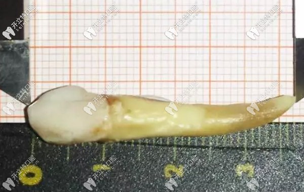 人的智齒較長有幾厘米，3.72厘米的牙齒你見過嗎？