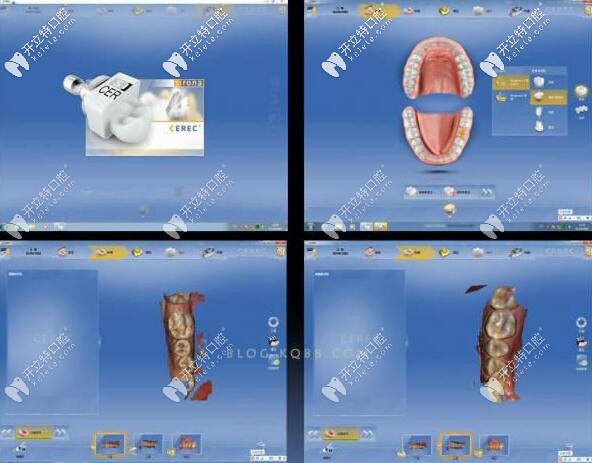 CAD/CAM設(shè)計